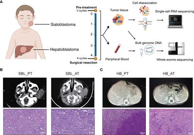 The Cellular and Molecular Landscape of Synchronous Pediatric Sialoblastoma and Hepatoblastoma